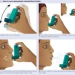 can you explain the correct inhaler techniques 1