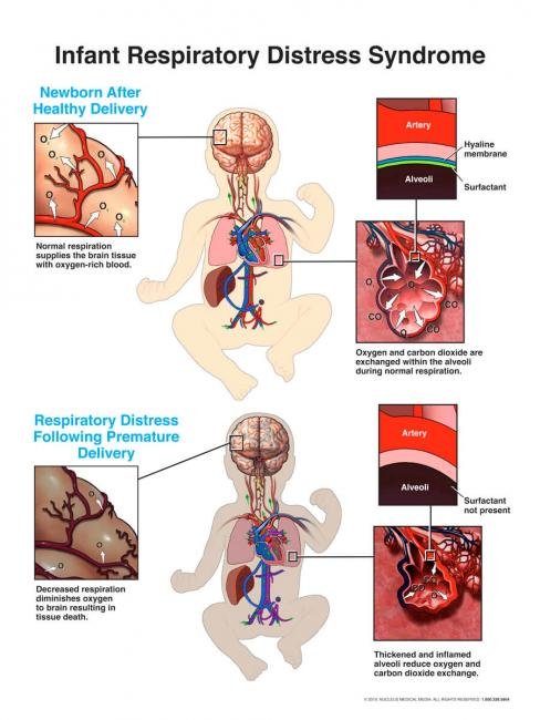 Can You Explain The Signs Of Respiratory Distress In Infants And Children?