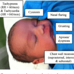 Can You Explain The Signs Of Respiratory Distress In Infants And Children? 10 can-you-explain-the-signs-of-respiratory-distress-in-infants-and-children-2
