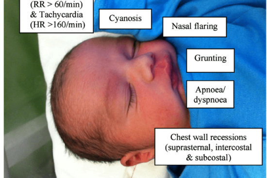 can-you-explain-the-signs-of-respiratory-distress-in-infants-and-children-2
