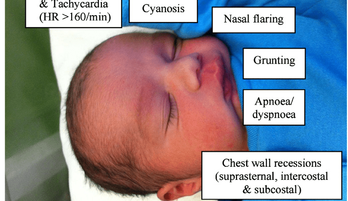 can-you-explain-the-signs-of-respiratory-distress-in-infants-and-children-2