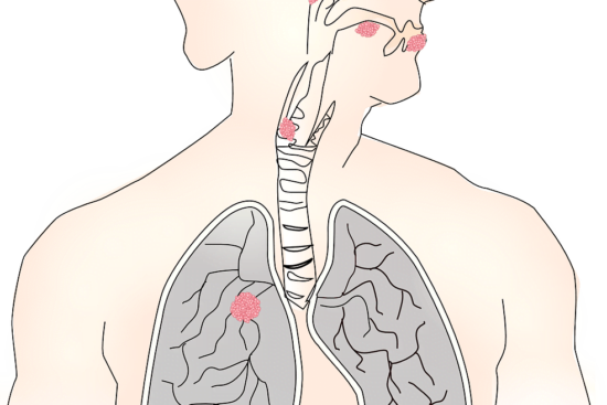 can-your-lungs-get-better-after-pulmonary-rehab