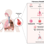 Does Pulmonary Rehab Improve Lung Function? 9 does-pulmonary-rehab-improve-lung-function