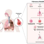 Does Pulmonary Rehab Improve Lung Function? 13 does-pulmonary-rehab-improve-lung-function