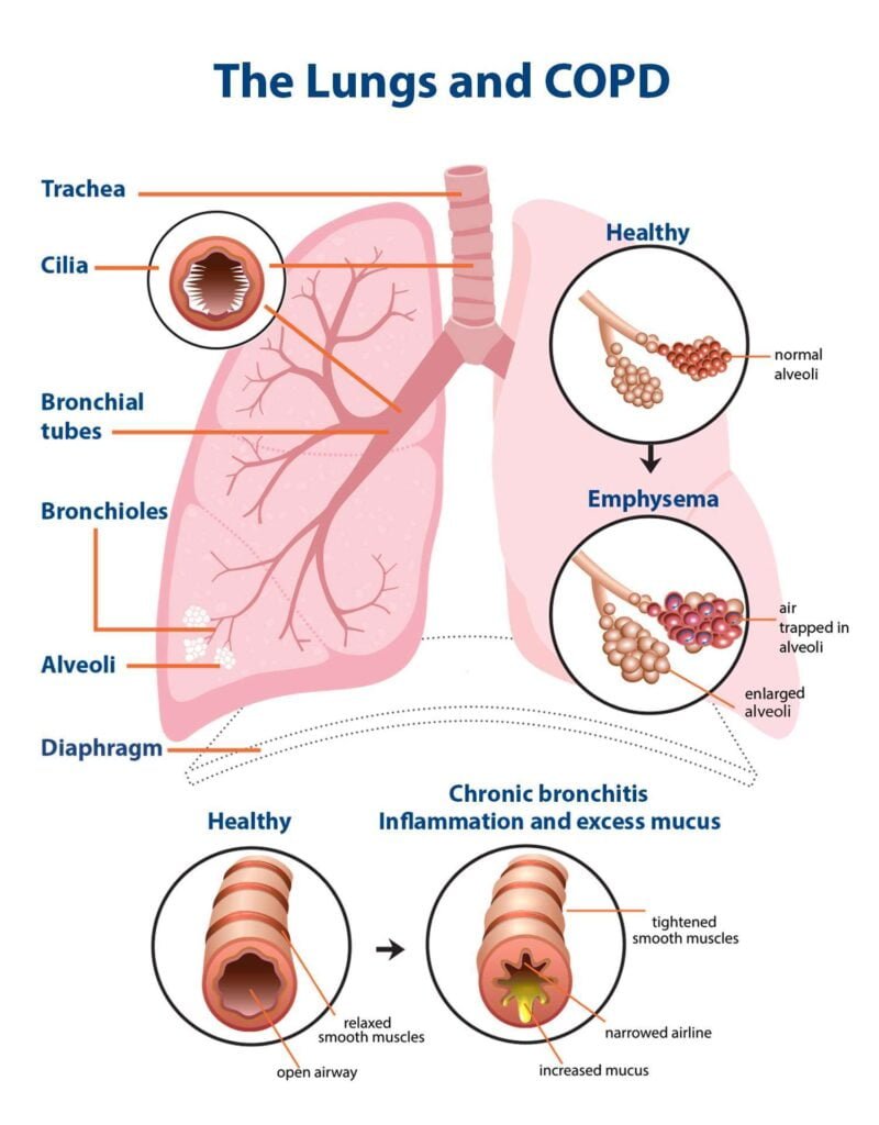 How Does COPD Affect You Physically? How Does COPD Affect You Physically?
