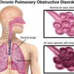 How Does COPD Affect You Physically? 10 how-does-copd-affect-you-physically