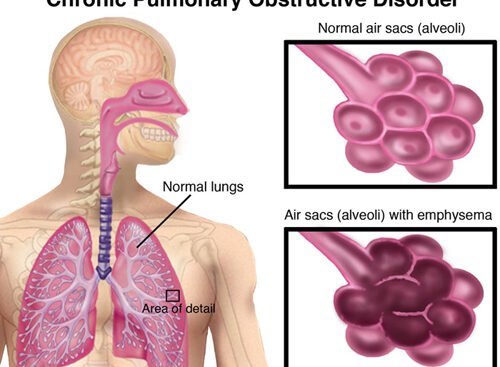 how-does-copd-affect-you-physically