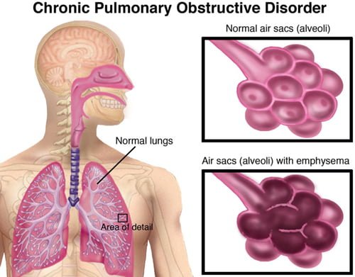 How Does COPD Affect You Physically? 1 how-does-copd-affect-you-physically