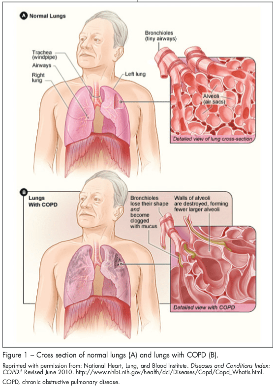 How Does COPD Affect You Physically? How Does COPD Affect You Physically?